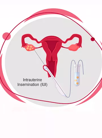 Best Intrauterine Insemination (IUI) Treatment in Newtown, Kolkata