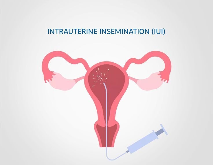 You are currently viewing IUI Treatment in Kolkata: Simple Help for Families